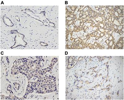 Ferroptosis in Intrahepatic Cholangiocarcinoma: IDH1105GGT Single Nucleotide Polymorphism Is Associated With Its Activation and Better Prognosis